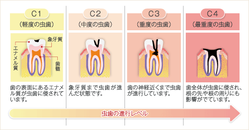 虫歯の進行レベル