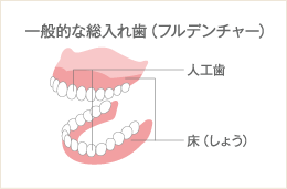 一般的な総入れ歯（フルデンチャー）